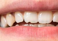 How Much Does a Chipped Tooth Cost to Repair?