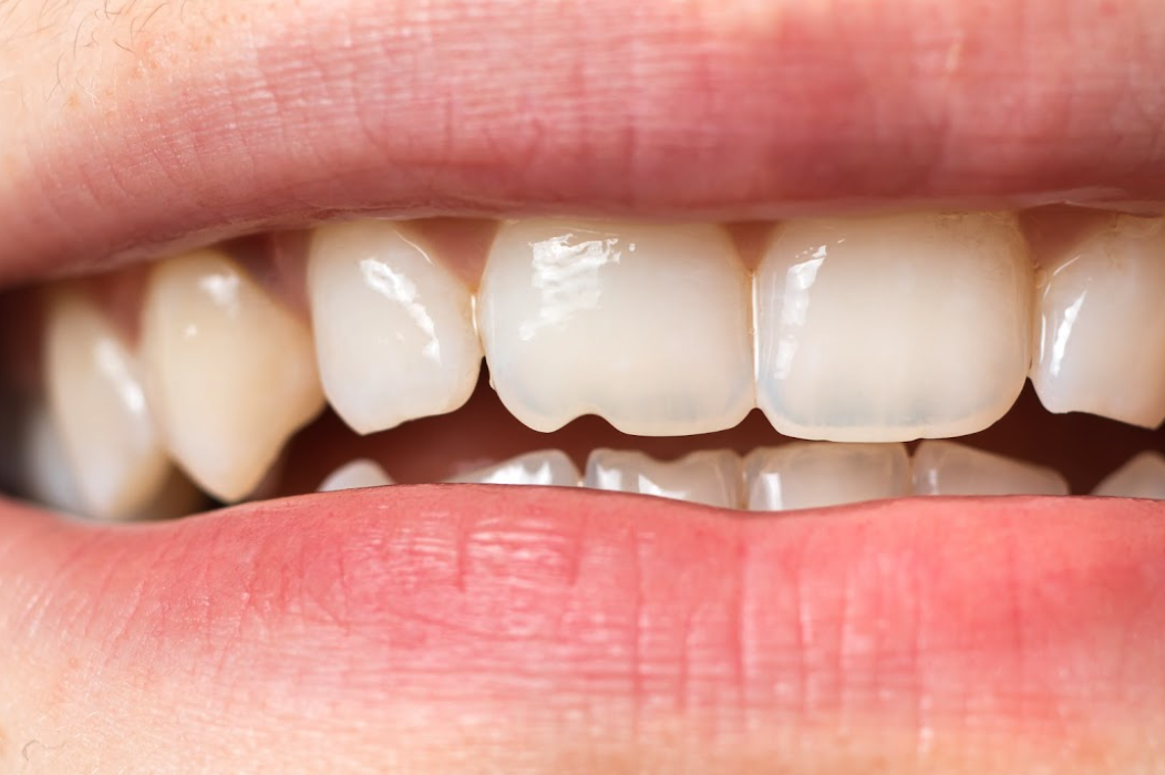 How Much Does a Chipped Tooth Cost to Repair?