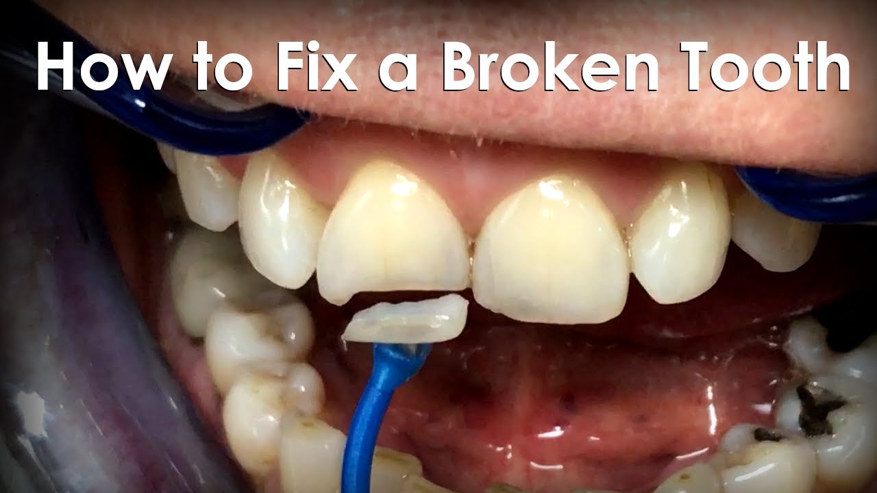 How to Repair a Cracked Tooth at Home: A Step-by-Step Guide